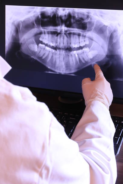 Emergency Dental Filling Replacement in LA